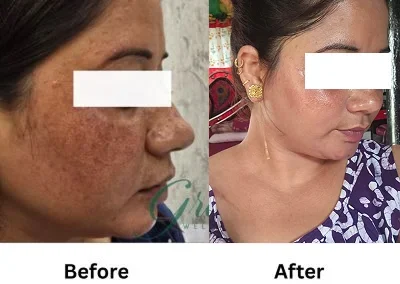 Before-After | The Grace Wellness