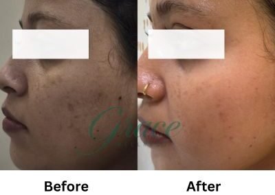 Before-After | The Grace Wellness