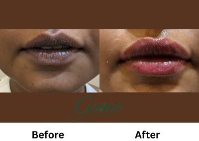 Before-After | The Grace Wellness