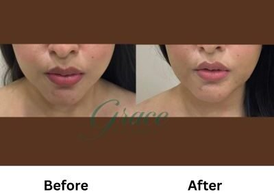Before-After | The Grace Wellness