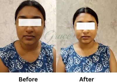 Before-After | The Grace Wellness